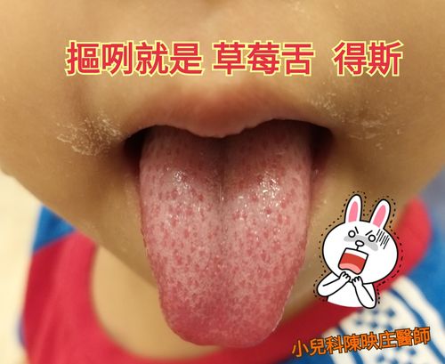 小孩的舌头像草莓红点一样正常吗：小时候披着床单玩的像个疯子
