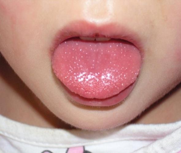 小孩的舌头像草莓红点一样正常吗：小时候披着床单玩的像个疯子